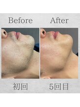 サンライズ(Sunrise)/約3ヶ月で髭剃りが楽に！