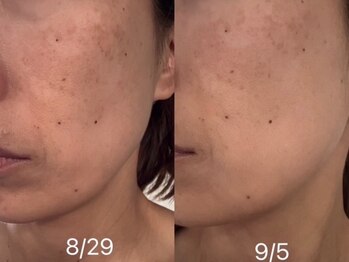 エステティックサロンアンドスクール ルトゥール(Retour)/Before After