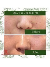 ラプリ 仙台店(Raplit stella)/ハーブピーリング/ニキビケア