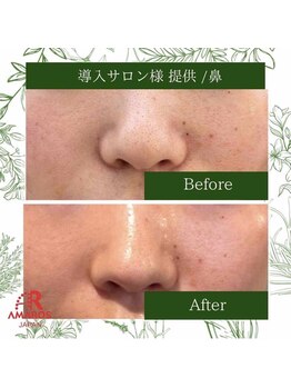 ラプリ 仙台店(Raplit stella)/ハーブピーリング/ニキビケア