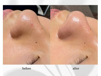 アン ビューティー(ann beauty)/施術1回【症例写真】10代