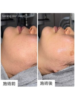 サラン スキンサロン(Sarang skin salon)/川西｜小顔 リフトアップ