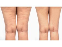 ティーダ(Ti-Da)/太もも裏のセル脂肪を放置No