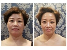 アゴラ/【小顔】【中国での実績もあり】