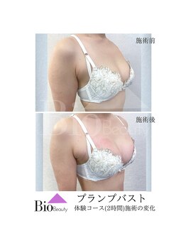 バイオビューティー 神戸本店(Bio Beauty)/プランプバスト　施術症例
