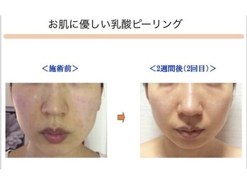 ベッラドンナ(Bella donna)/肌荒れ BeforeAfter