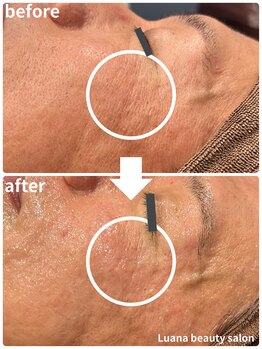 ルアナ(Luana)/【人気NO.1】陶肌トリートメント