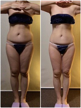 ツボミ(TSUBOMI)/モニター様 before・after