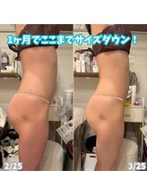 ビアル(VIALU)/ライポソニックスでサイズダウン