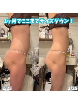 ビアル(VIALU)/ライポソニックスでサイズダウン