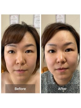 サロン ド アヤ(salon de Aya)/一回施術だけでリフトアップ小顔