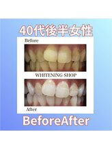 ホワイトニングショップ 西原店/40代後半女性☆BeforeAfter