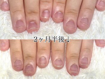 グラシナ なんば店/深爪/自爪育成/フィルイン