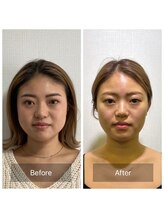 シャルム(CHARMEB)/きつい食いしばりにも美容鍼