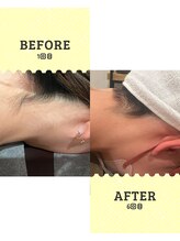 シール(Syl)/うなじ脱毛