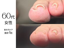 フットケア クラッシー(footcare classy)/人差し指も巻き爪ケア中♪