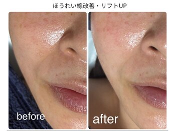 グロウ バイ フェイシャルデザイン アンド アイ(GROW)/ほうれい線改善