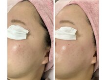 ルル(RuRu)/ Wax脱毛