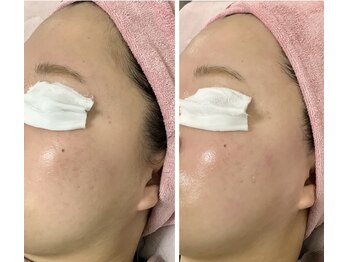 ルル(RuRu)/ Wax脱毛