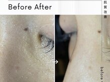 エミナル(EMINAL)/毛穴詰まり解消メニュー