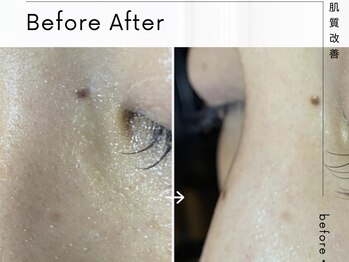 エミナル(EMINAL)/毛穴詰まり解消メニュー