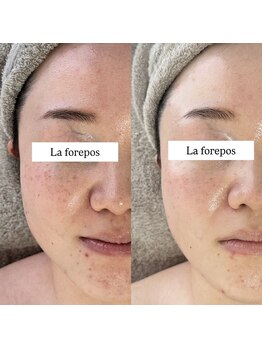 ラ フォルポ 恵比寿(La forepos)/剥けないハーブピーリング恵比寿