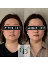 キュープ 富士店(Qpu)/キュッとしまります☆富士市小顔