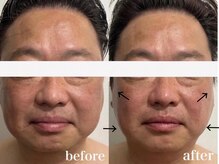 ベール(BEHL)/コルギのBefore After