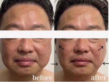 ベール(BEHL)/コルギのBefore After