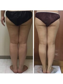 プリンセス バイ セイフティプリンセス 長野店(PRINCESS)/下半身痩せ特化メニュー