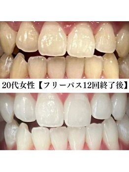 ホワイト 福岡天神店(WHITE)/ホワイトニングビフォーアフター