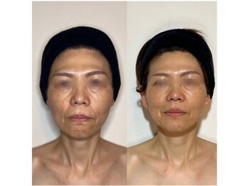 エム(M)/光糸リフト