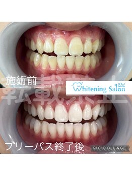 ホワイトニングサロン 名古屋 栄店/【ホワイトニング】