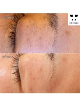 ルミラポー(Lumira Peau)/30代5回