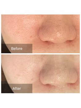 毛穴屋/毛穴開きにララピール