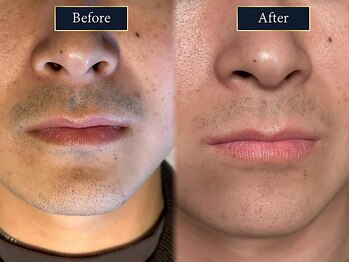 グラスト(Grast)/ヒゲ脱毛|福岡/大橋/天神/博多