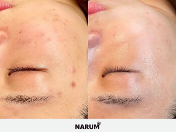 ナルムフェイシャル 代々木(NARUM facial)/エクソソームハーブピーリング