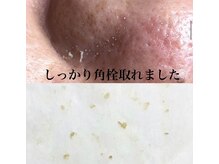 ビューティーネイル(Beauty Nail)/毛穴エクストラクション