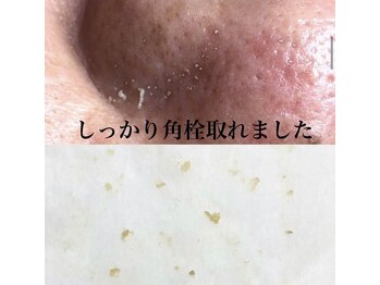 ビューティーネイル(Beauty Nail)/毛穴エクストラクション