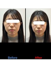 リノア 堀江(Linoa)/小顔矯正ビフォーアフター