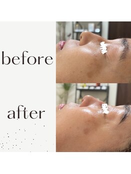 ミルル(milulu)/シワを緩和させピーン