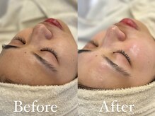 ザ パールズ(The Pearls)/一度で最強肌質改善☆