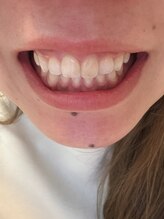 ムーンホワイトニング(Moonホワイトニング)/2回目でこの白さ