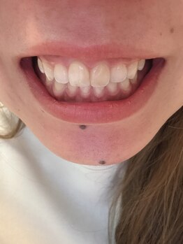 ムーンホワイトニング(Moonホワイトニング)/2回目でこの白さ