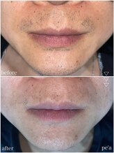 ペア(pe'a)/脱毛before★after[ヒゲ]