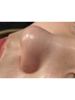 毛穴ケアをしたい