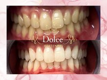 ドルチェ(Dolce)/ビフォーアフター