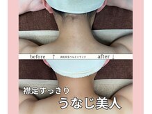 浜松富塚ベルミーランド/脱毛Before→After