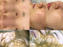 クレドペール(Eclat de Perles)/ニキビ、赤み、毛穴のお悩み。