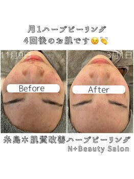 エヌプラス(N+)/20代女性＊ピーリング4回後(3)